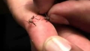 DOĞA ŞİFADIR... Cerrehi karıncalar...