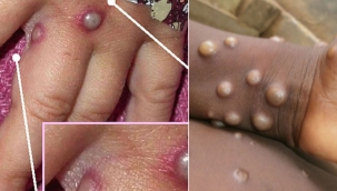 MAYMUN ÇİÇEĞİ HASTALIĞI