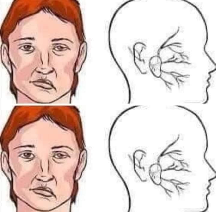 İnme (Felç) geldiğinde yapılacak ufak bir hareket felç olmaktan kurtarabilir...