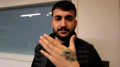 Dövme sildirmek isterken kabusu yaşadı, elindeki dokular öldü