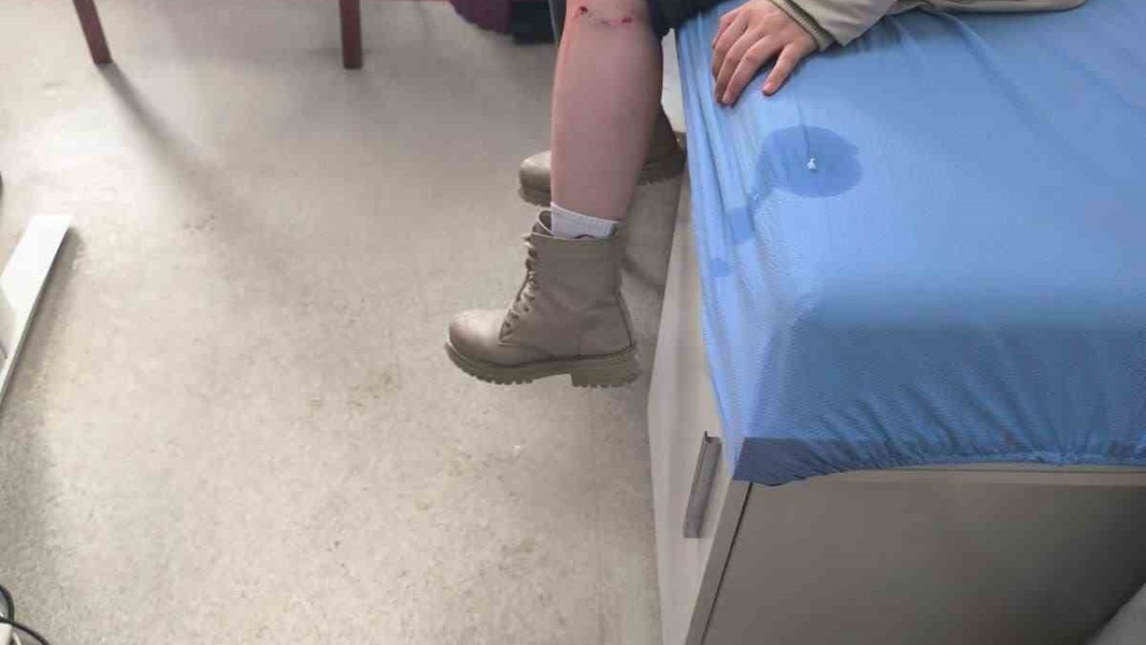 Kayseri’de sokak köpeğinin saldırısına uğrayan çocuk yaralandı