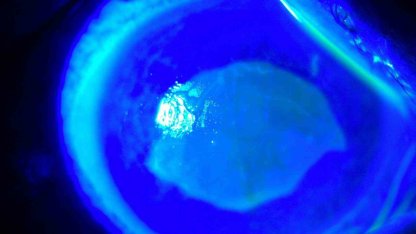 ’Kırlangıç otu kullanımı’na dikkat, uzmanlar uyarıyor: "Gözlerine suyunu damlattı, göremez hale geldi"